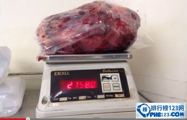 世界上最大的肾脏：重达5千克