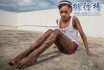 世界十大罕见病:变成活死人还长出多个乳房