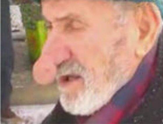 世界上最大的鼻子：土耳其老人鼻子长14厘米