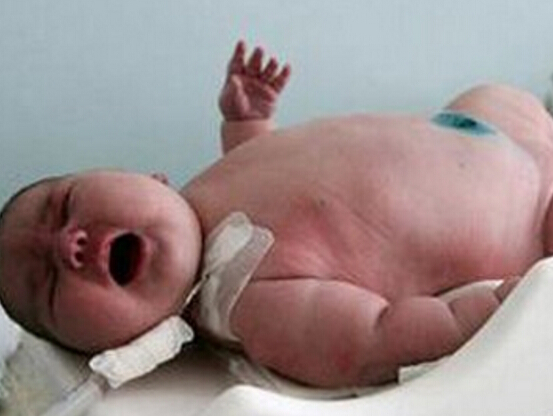 世界上出生最重的婴儿，澳大利亚产妇诞下37斤巨婴