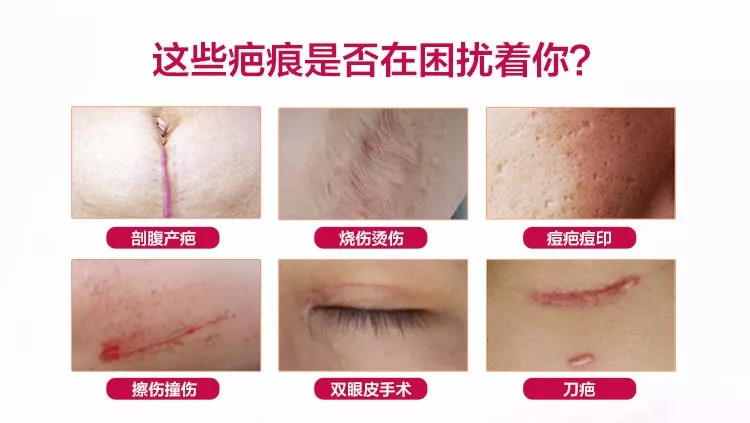 祛疤膏哪个牌子好？十款知名度最高的祛疤产品