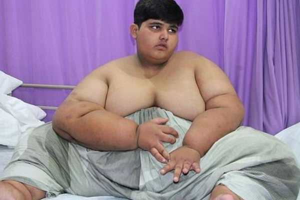 世界上最胖的孩子，仅10岁体重就达394斤