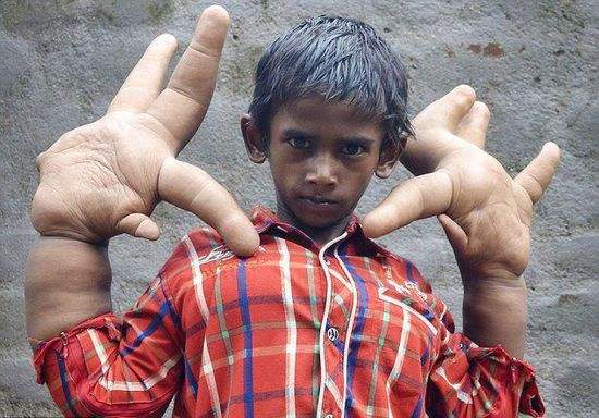 世界罕见巨指症男孩，双手重达12.7公斤