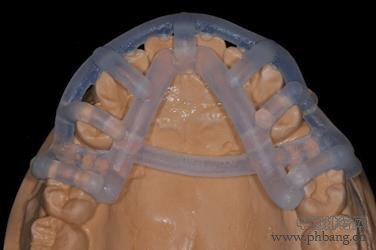 3d打印对未来的影响：Stratasys3D打印技术提高植牙