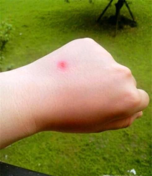 被蜜蜂咬伤后怎样处理？