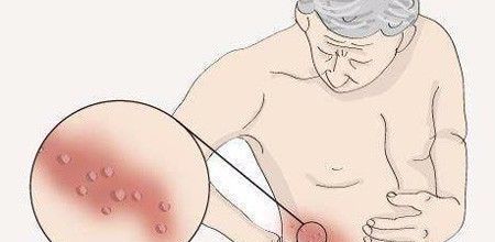 缠腰龙到底是什么东西？流传腰上长一圈就寿命已尽？