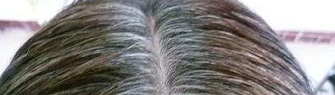 人的头发为什么会变白？