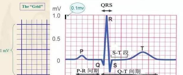 教你如何看懂心电图