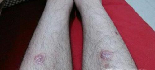 皮癣的真实图片