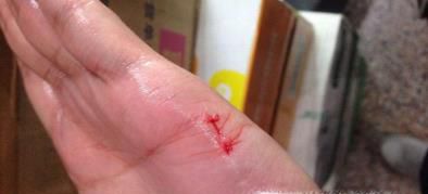 被猫抓了怎么办