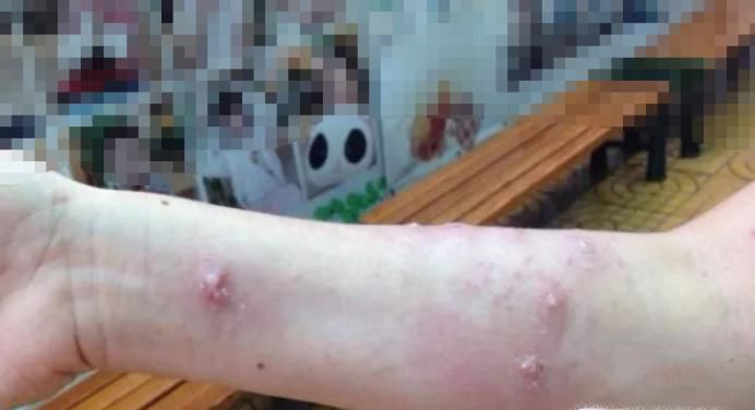 被蚂蚁咬伤 又红又肿又疼又痒怎么办