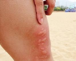 海边游玩被海蜇蜇咬应如何处理