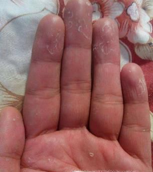 手指脱皮是怎么回事