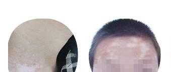 怎么区别它是不是白殿风，白色糠疹用什么药?