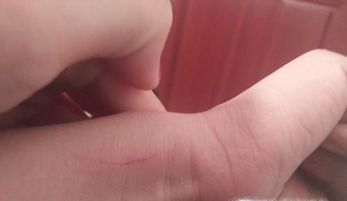 被猫抓伤破皮没出血怎么办