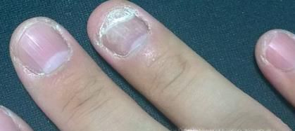 灰指甲初期症状图片