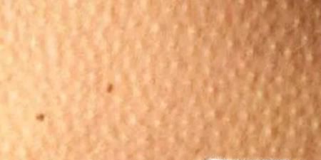 手臂上有小疙瘩 手臂上有鸡皮疙瘩