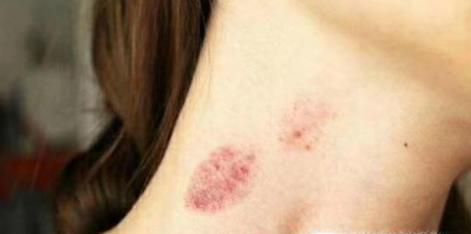 草莓印怎么消除？