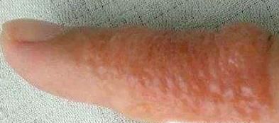 夏天手上长小水泡,刺痒难耐,怎么办