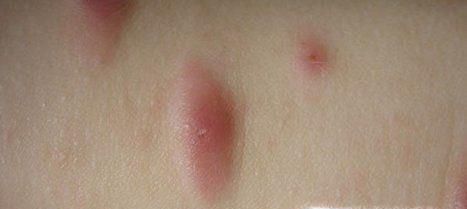 螨虫叮咬后的症状图