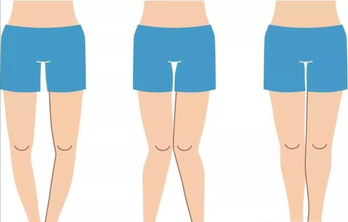 腿型不好看怎么矫正