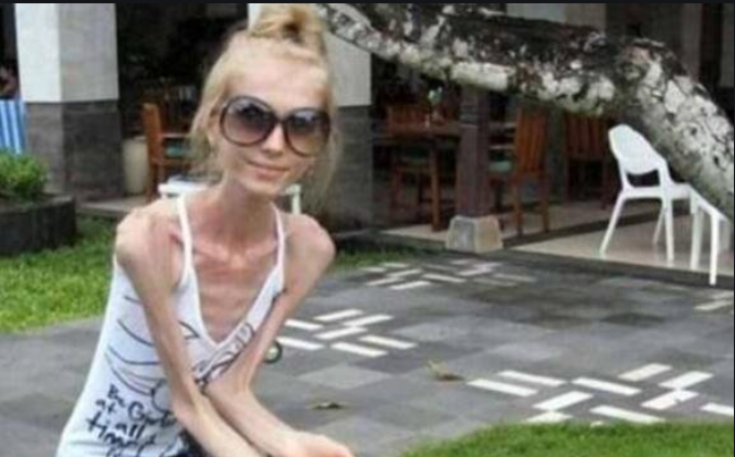 世界上最瘦的人