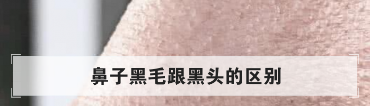 鼻子黑毛跟黑头的区别