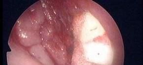 腺样体肥大我是这样给宝宝调理的