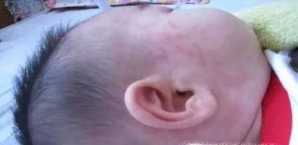 正确处理幼儿急疹