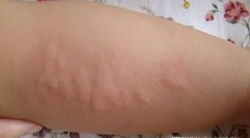 孩子得了过敏性荨麻疹怎么办