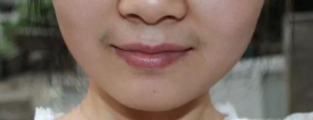 女生嘴唇上方长胡子怎么办?怎么去掉?