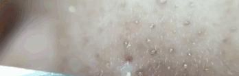 如何清洁黑头和粉刺