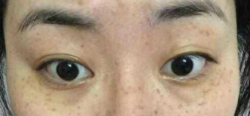 女性脸上长斑的5大原因