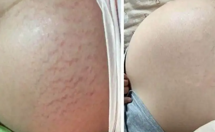 青柠汁多久去妊娠纹