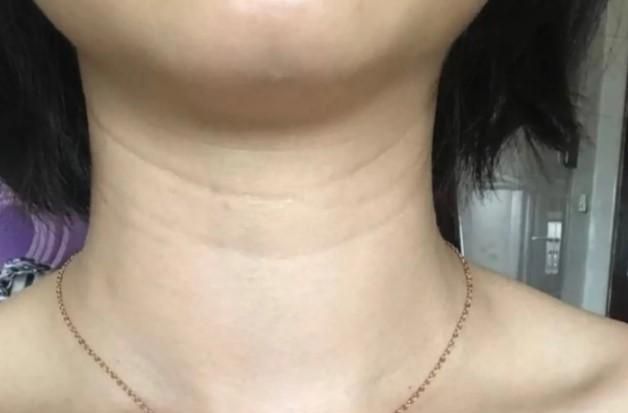 颈纹是怎么形成的