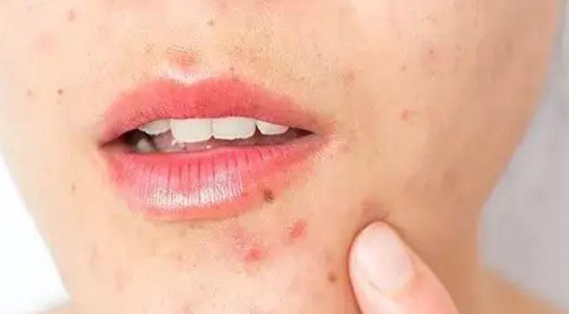 去除痘痘合适的方法