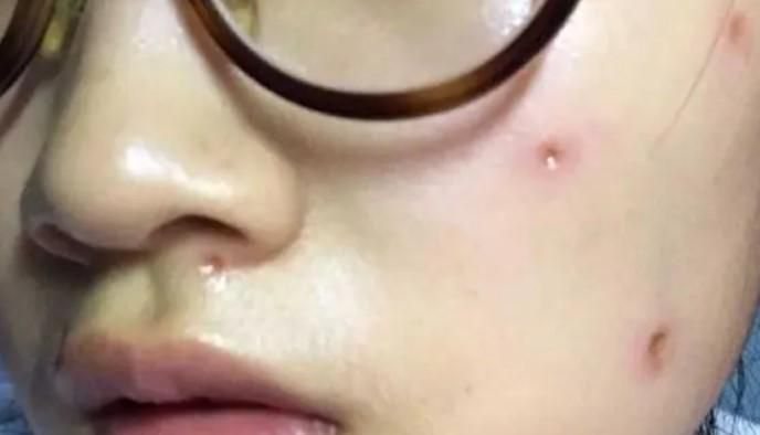 点痣要注意什么吗