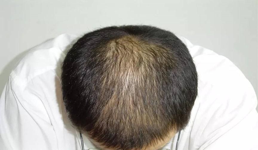 30岁脱发要怎么调理