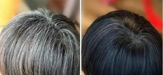 产生白发的原因