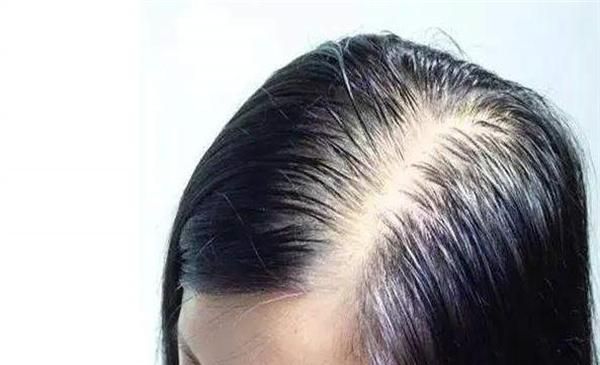 脱发多少根才是算正常的