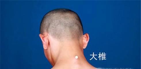 中医教你如何拔罐治感冒