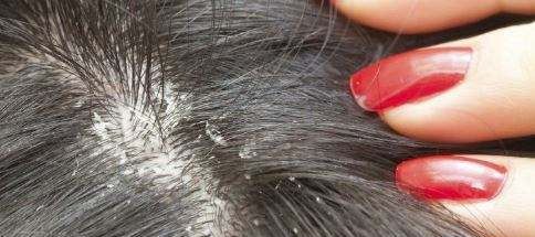 头皮屑多是什么原因？去头皮屑最好的方法