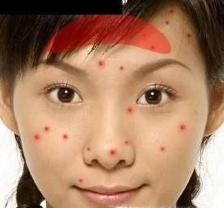 脸上不同位置长痘痘，从痘痘看身体状况！