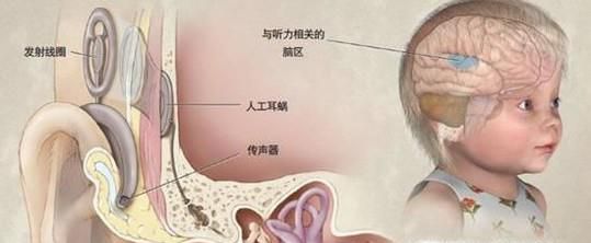 助听器和人工耳蜗的区别