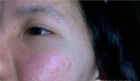 什么是红皮病 红皮病的病因有哪些