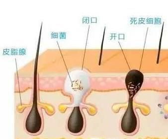 怎样用维生素B6去闭口