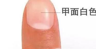 根据指甲判断身体健康状况