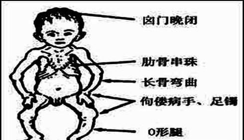 佝偻病与软骨病的区别