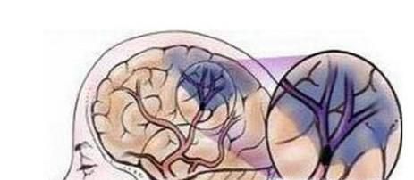 怎样科学预防脑梗塞？