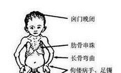 佝偻病会影响身高吗？